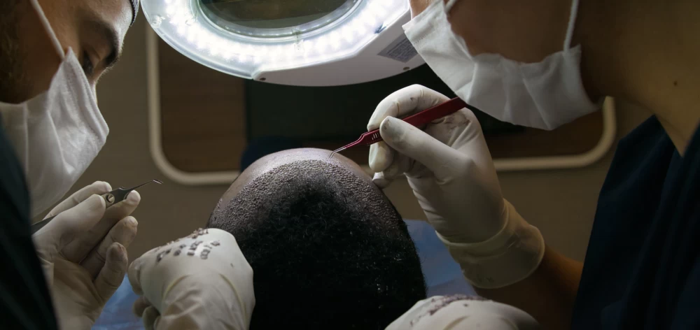 Advantages Of FUE Method In Hair Transplant