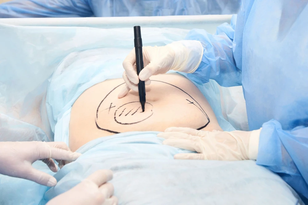 Liposuction Yaptıranlar ve Sonrası