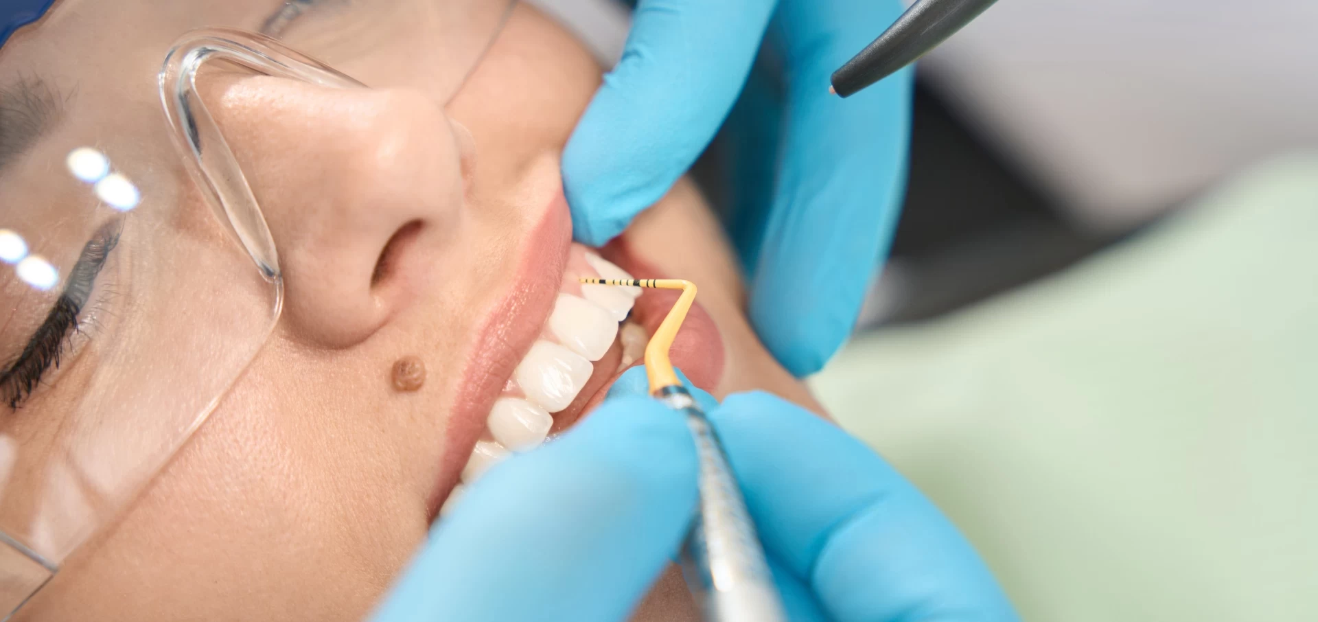 Tartar Removal Plaque Removal Cost Yücel Sarıaltın