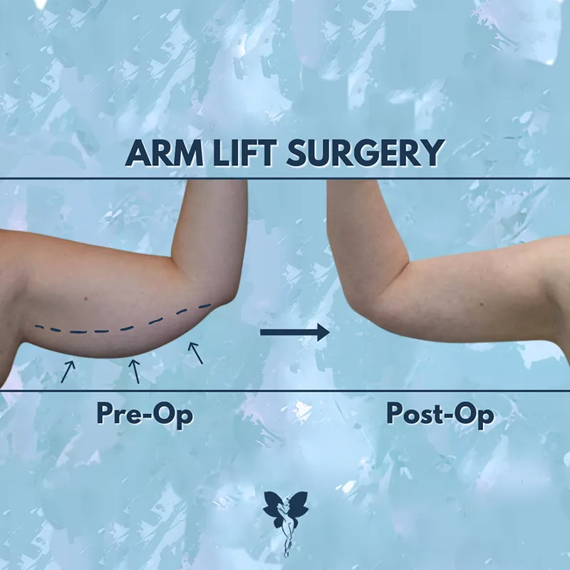 arm lift