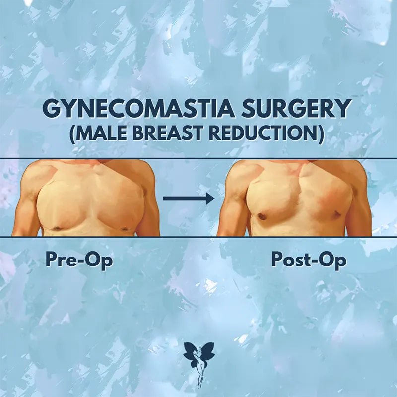 gynecomastia